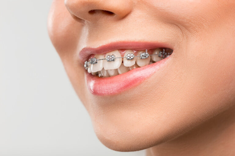 Ortodonta Sopot przesuwa zęby