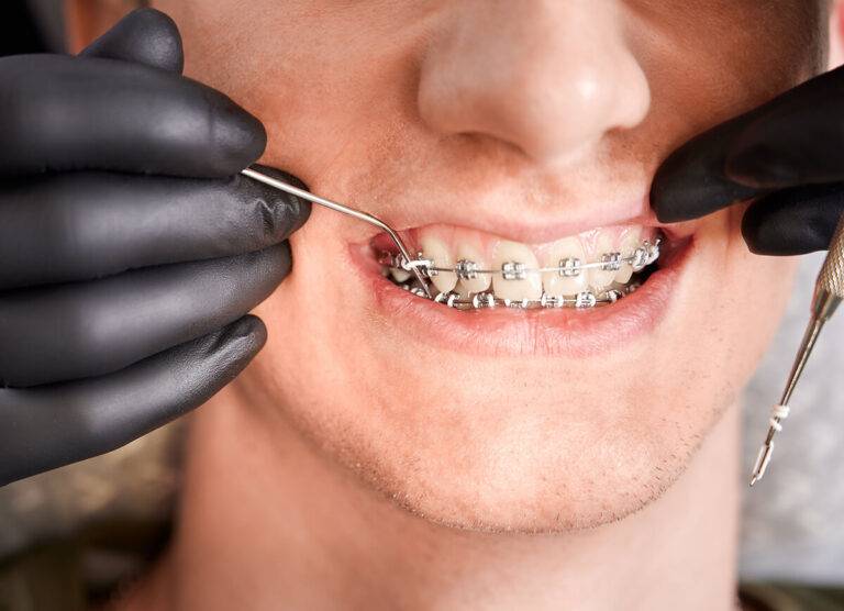 Leczenie ortodontyczne – jak je zaplanować i kiedy warto zacząć?