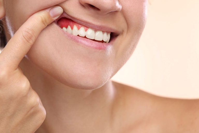 Krwawiące dziąsła – przyczyny, leczenie i kiedy zgłosić się do dentysty